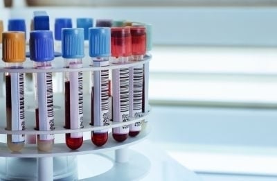 Japon: vers un simple test sanguin pour dépister 13 types de cancer