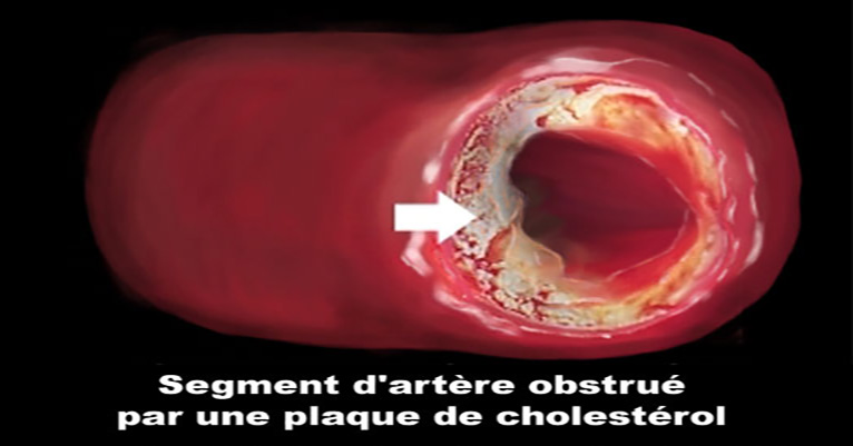 cholesterol2