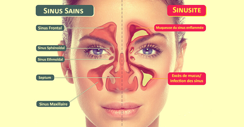 infection-sinus
