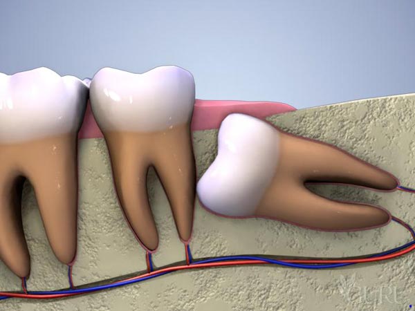 dents-de-sagesse