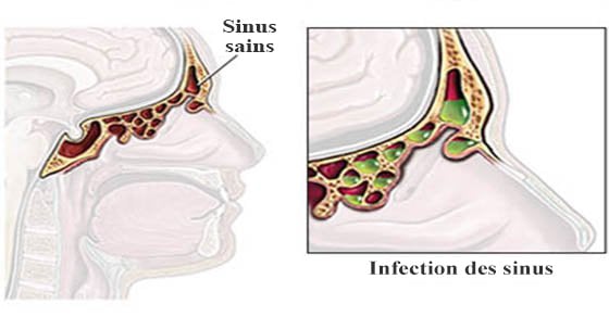 infection-des-sinus