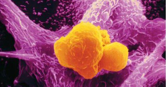 curcuma-cancer