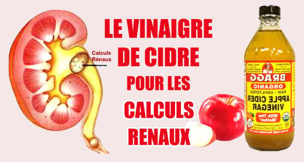 vinaigre-de-cidre-calculs-renaux