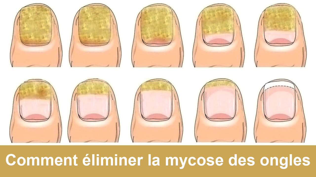 Comment éliminer rapidement et naturellement la mycose des ongles de