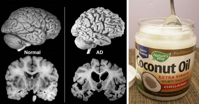 Il mange 2 cuillères à soupe d'huile de coco deux fois par jour pendant 60 jours et voici ce qui arrive à son cerveau !