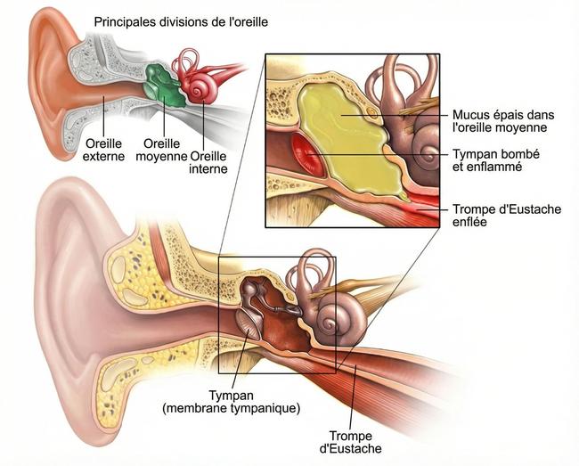 Otite : 3 remèdes naturels efficaces pour soulager la douleur