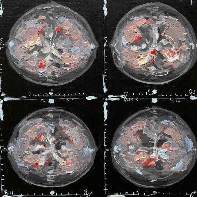 Mammographies : quand le dépistage peut augmenter le risque