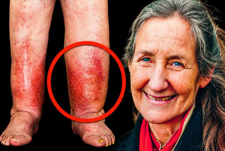 15 ans de jambes et de pieds enflés, disparus en quelques minutes ! La découverte SECRÈTE de Barbara O'Neill