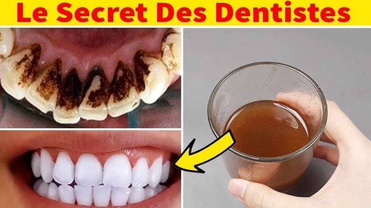Éliminez rapidement la plaque et le tartre avec ces 4 ingrédients